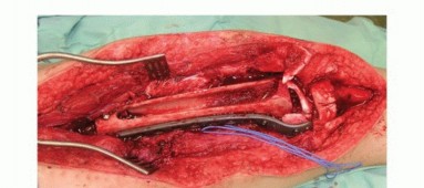 Illustration 35 for Free Vascularized Fibular Grafts: Solving Complex Bone Defects
