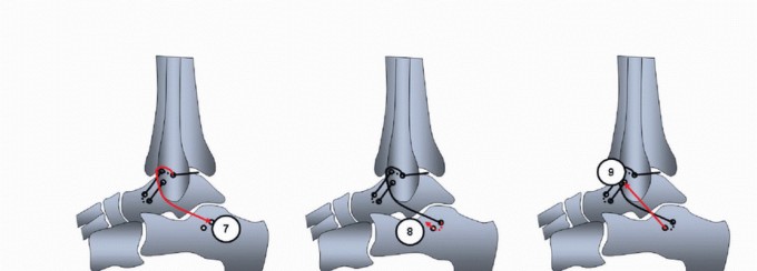 Regain Ankle Stability: Solutions for Chronic Lateral Instability