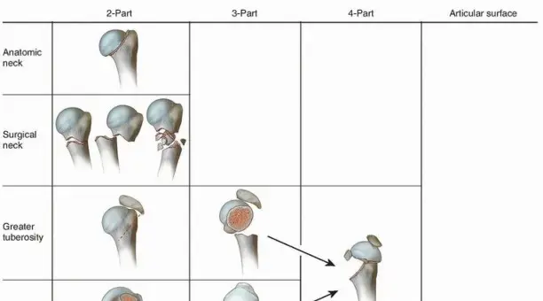 صورة توضيحية لـ كسور أعلى عظم العضد: دليل شامل للمرضى لاستعادة صحة الكتف بقلم الأستاذ الدكتور محمد هطيف