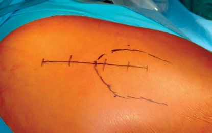 Illustration 31 for Direct Lateral Hip: Optimize Exposure with Sharp Curved Hohmann