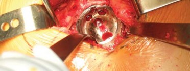 Illustration 103 for Successful Total Hip Replacement in Developmental Dysplasia