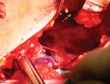 Illustration 7 for Mastering the Anterolateral Approach in Minimally Invasive Hip Replacement
