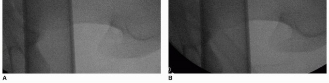 Illustration 31 for Beyond Knee Surg: Hip Arthroscopy for Sports Injuries