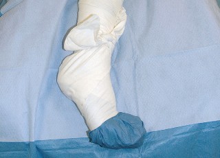 Illustration 9 for Unlock the Figure Posterior Approach to the Hip