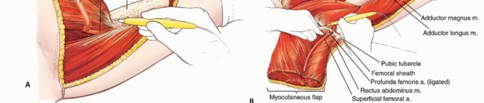 Illustration 27 for Anterior Flap Hemipelvectomy: Leveraging fig tech fig for Difficult Tumors