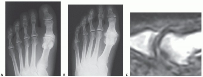 Mastering Extensive Plantar Release for Hallux Rigidus