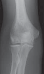Illustration 5 for Precision Arthroscopy for Chondral Injuries & OCD: Direct Lateral Portal