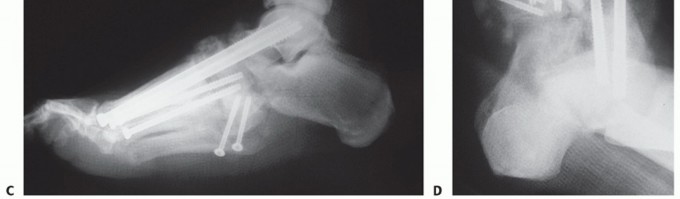 Illustration 23 for Regain Mobility: Surgical Solutions for Charcot Foot Arthropathy