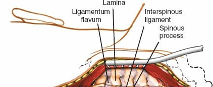 Illustration 181 for Approach to the Lumbar Spine: Mastering Techniques & Anatomy