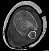 Tibial Fracture Extending into the Plafond: Intramedullary Secrets