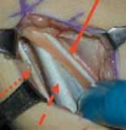 Illustration 5 for Unlocking Mobility: Distal Lengthening for Lateral Hamstring Muscle