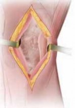 Illustration 22 for Guide Pin Assembly: Key to Flawless Upper Tibial Osteotomy