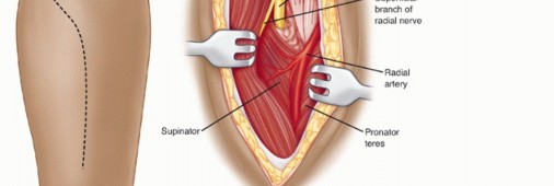 Illustration 59 for Surgical Approaches to Shoulder & Elbow: Pearls and Pitfalls