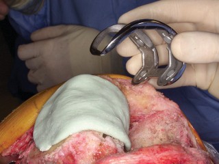 Illustration 30 for PROSTALAC Articulating Spacer: Treat Infected Knees, Regain Mobility