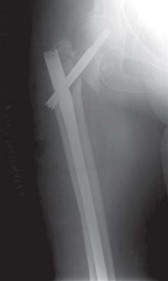 Illustration 7 for Effective Arthroplasty for Salvage of Failed Hip Fixation