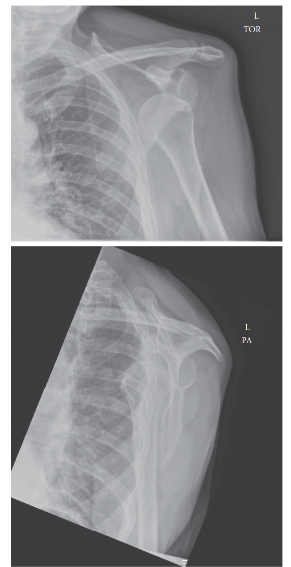 Shoulder Dislocation Anterior: Urgent ER Management Guide
