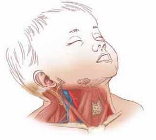 SCM Release for Torticollis: Optimal Timing by Year of Age