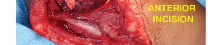 Illustration 26 for Distal Humeral Resection: Safe Techniques for Limb Preservation