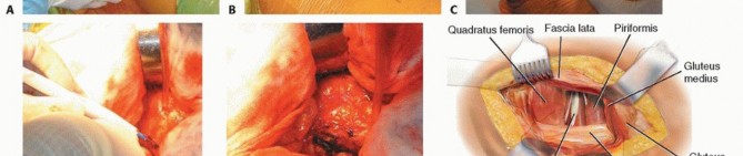 Illustration 45 for Hemiarthroplasty of the Hip: Indications & Types Explained