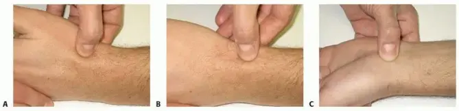 صورة توضيحية لـ عدم التئام الكسر الزورقي (العظم الزورقي) وفقدان التروية الدموية: دليل شامل للمرضى مع الأستاذ الدكتور محمد هطيف