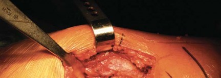 Illustration 10 for Metal on Metal Resurfacing: Enhanced Posterior Soft Tissue Repair
