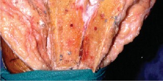 Illustration 9 for The Principles of Revision TKR: Avoid Pitfalls, Ensure Success