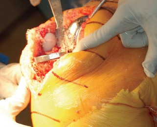 Illustration 29 for Mastering Gap Balancing in Revision TKA: Avoid Common Pitfalls