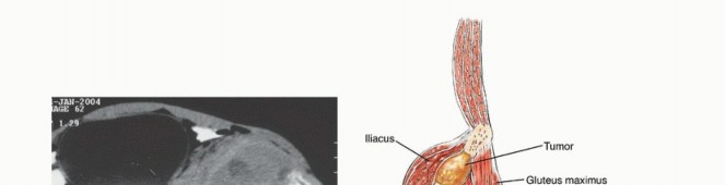 Illustration 15 for Pelvic Metastasis Surgery: A Component of the Utilitarian Approach