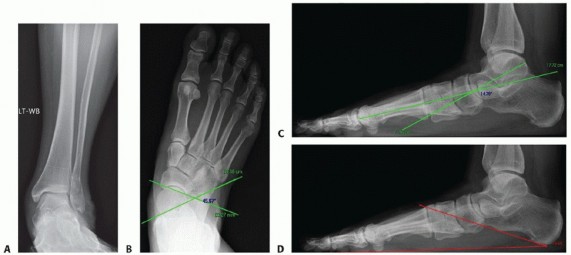 Illustration 3 for Lateral Column Lengthening: Relieve Flatfoot Pain & Correct Deformity