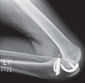 Illustration 31 for Knee Arthroplasty Unicondylar: Discover if Partial Knee Replacement is Right