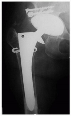 Illustration 18 for Revision THA: Why Extensively Porouscoated Cylindrical Stems Excel