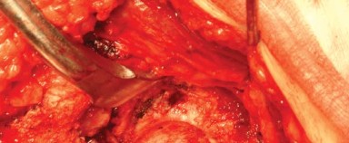 Illustration 16 for Approaches Posterolateral Surgical: A Guide to Enhanced Hip Surgery