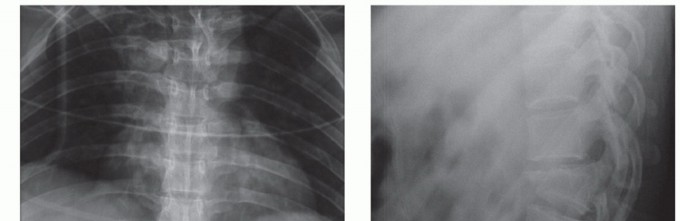 Unlock Thoracic Relief: Costotransversectomy for Canal Decompression