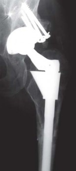 Illustration 115 for Successful Total Hip Replacement in Developmental Dysplasia