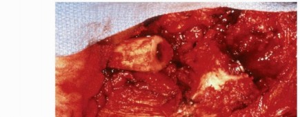 Illustration 8 for Recreate Hip Biomechanics: Modular Stems for Modular Solutions