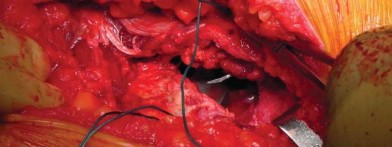 Illustration 60 for Unlock better THA: The technique of short stem for less invasiveness