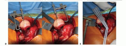 Illustration 8 for Hip Resurfacing: The Bone-Sparing Solution around the Femoral Head