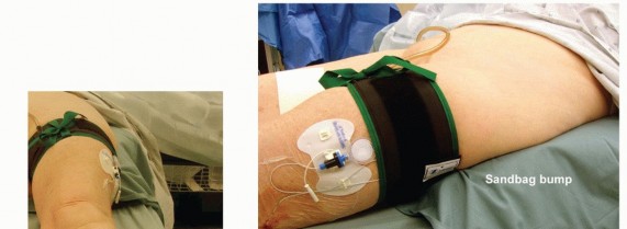 Illustration 5 for Lateral Column Lengthening: Relieve Flatfoot Pain & Correct Deformity