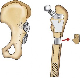 Illustration 133 for Successful Total Hip Replacement in Developmental Dysplasia