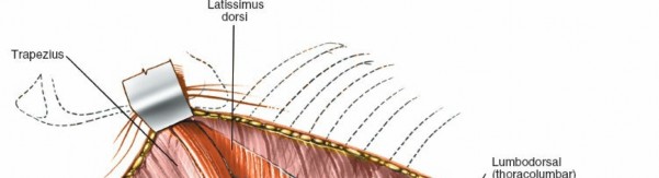 Illustration 399 for Approach to the Lumbar Spine: Mastering Techniques & Anatomy