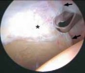 Illustration 32 for Solving Hip Soft Tissue Pathology with Advanced Arthroscopy