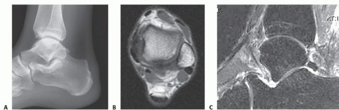 Relieve Haglund's Pain: Endoscopic Treatment for Bursa and Paratenon