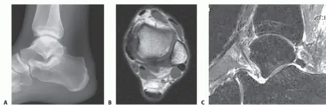 صورة توضيحية لـ وداعاً لألم الكعب المزمن: الدليل الشامل لمتلازمة هاغلوند وعلاجها بالمنظار مع الأستاذ الدكتور محمد هطيف