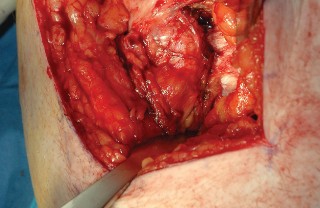 Illustration 5 for Femoral Stem Revision: Posterior Approach for Better Outcomes