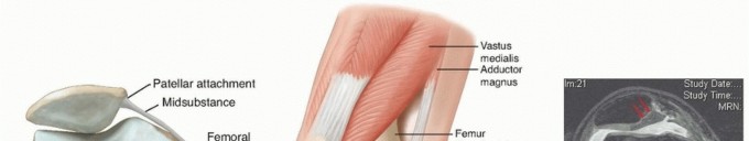 Chronic Patellar Instability: From Acute Onset to Lasting Solutions