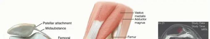 صورة توضيحية لـ عدم استقرار الرضفة (خلع صابونة الركبة): دليلك الشامل للتشخيص والعلاج والتعافي مع الأستاذ الدكتور محمد هطيف