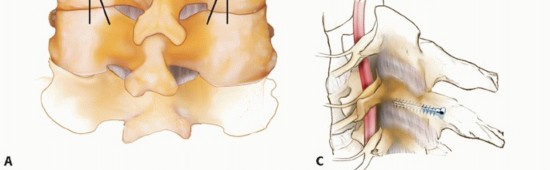Illustration 20 for Achieve Stability: Posterior Cervical Lateral Mass Screw Fusion