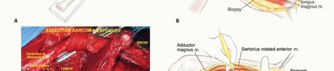 Illustration 8 for Optimizing Adductor Muscle Group Resection for Limb Preservation