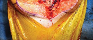 Illustration 55 for Mastering TKA: Essential Methods of Rotational Alignment