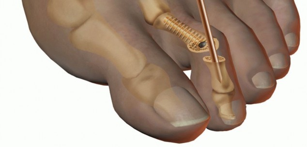 Illustration 28 for Hammer Toe Correction: Understanding the Extensor Digitorum Longus